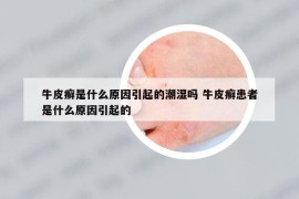 牛皮癬是什么原因引起的潮濕嗎 牛皮癬患者是什么原因引起的