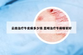 云南治療牛皮癬多少錢 昆明治療牛癬哪家好