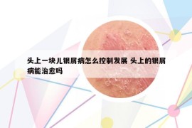 頭上一塊兒銀屑病怎么控制發(fā)展 頭上的銀屑病能治愈嗎