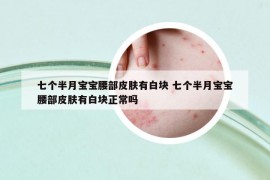 七個(gè)半月寶寶腰部皮膚有白塊 七個(gè)半月寶寶腰部皮膚有白塊正常嗎