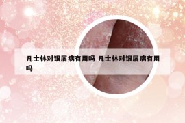 凡士林對(duì)銀屑病有用嗎 凡士林對(duì)銀屑病有用嗎