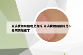 點(diǎn)滴狀銀屑病晚上變癢 點(diǎn)滴狀銀屑病癢是不是病情加重了