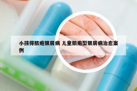 小孩得膿皰銀屑病 兒童膿皰型銀屑病治愈案例
