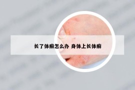 長(zhǎng)了體癬怎么辦 身體上長(zhǎng)體癬