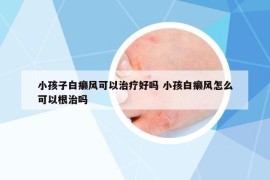 小孩子白癩風(fēng)可以治療好嗎 小孩白癩風(fēng)怎么可以根治嗎