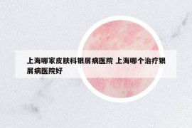 上海哪家皮膚科銀屑病醫(yī)院 上海哪個(gè)治療銀屑病醫(yī)院好