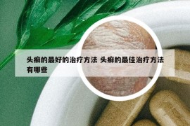 頭癬的最好的治療方法 頭癬的最佳治療方法有哪些