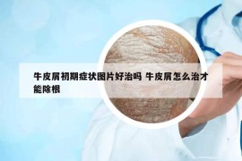 牛皮屑初期癥狀圖片好治嗎 牛皮屑怎么治才能除根