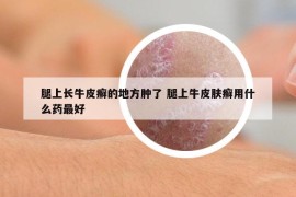 腿上長(zhǎng)牛皮癬的地方腫了 腿上牛皮膚癬用什么藥最好