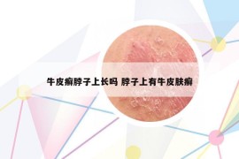 牛皮癬脖子上長(zhǎng)嗎 脖子上有牛皮膚癬