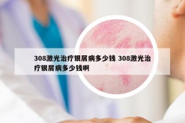 308激光治療銀屑病多少錢 308激光治療銀屑病多少錢啊