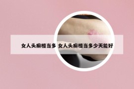 女人頭癬相當(dāng)多 女人頭癬相當(dāng)多少天能好