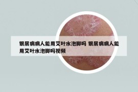 銀屑病病人能用艾葉水泡腳嗎 銀屑病病人能用艾葉水泡腳嗎視頻