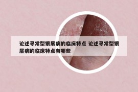 論述尋常型銀屑病的臨床特點(diǎn) 論述尋常型銀屑病的臨床特點(diǎn)有哪些