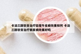 卡泊三醇軟膏治療輕度牛皮癬效果如何 卡泊三醇軟膏治療銀屑病效果好嗎
