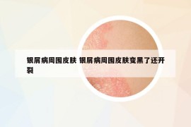 銀屑病周?chē)つw 銀屑病周?chē)つw變黑了還開(kāi)裂