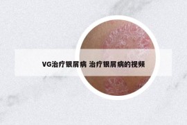 VG治療銀屑病 治療銀屑病的視頻