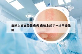 肩膀上日光暈是癬嗎 肩膀上起了一塊干燥像癬