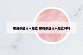 銀屑病越治人越虛 銀屑病越治人越虛弱嗎