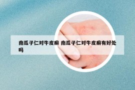 南瓜子仁對(duì)牛皮癬 南瓜子仁對(duì)牛皮癬有好處嗎