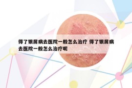 得了銀屑病去醫(yī)院一般怎么治療 得了銀屑病去醫(yī)院一般怎么治療呢