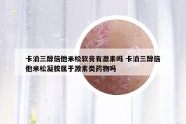 卡泊三醇倍他米松軟膏有激素嗎 卡泊三醇倍他米松凝膠屬于激素類(lèi)藥物嗎