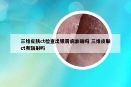 三維皮膚ct檢查出銀屑病準(zhǔn)確嗎 三維皮膚ct有輻射嗎