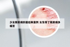 少女銀屑病折磨經(jīng)典案例 女生得了銀屑病多痛苦