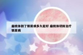 扁桃體割了銀屑病多久能好 扁桃體切除治療銀屑病