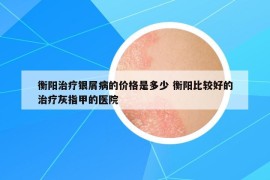 衡陽(yáng)治療銀屑病的價(jià)格是多少 衡陽(yáng)比較好的治療灰指甲的醫(yī)院