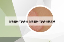 生物制劑打多少針 生物制劑打多少針銀屑病