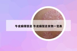 牛皮癬得禁忌 牛皮癬禁忌食物一覽表