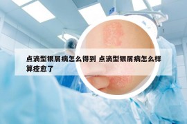 點(diǎn)滴型銀屑病怎么得到 點(diǎn)滴型銀屑病怎么樣算痊愈了