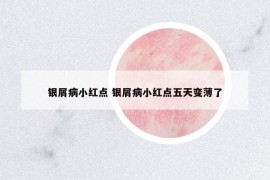 銀屑病小紅點(diǎn) 銀屑病小紅點(diǎn)五天變薄了
