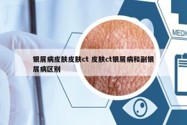 銀屑病皮膚皮膚ct 皮膚ct銀屑病和副銀屑病區(qū)別