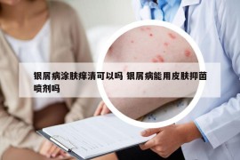 銀屑病涂膚癢清可以嗎 銀屑病能用皮膚抑菌噴劑嗎