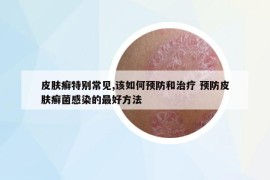 皮膚癬特別常見,該如何預(yù)防和治療 預(yù)防皮膚癬菌感染的最好方法