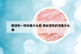 跟燙傷一樣的是什么癬 類似燙傷的泡是什么病