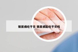 銀屑病吃干貝 銀屑病能吃干貝嗎