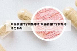 銀屑病治好了有黑印子 銀屑病治好了有黑印子怎么辦