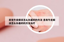 患有牛皮癬該怎么辦最好的方法 患有牛皮癬該怎么辦最好的方法治療