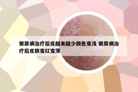 銀屑病治療后皮越來(lái)越少顏色變淺 銀屑病治療后皮膚變紅變薄