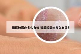 銀屑膠囊吃多久有效 銀屑膠囊吃多久有效?