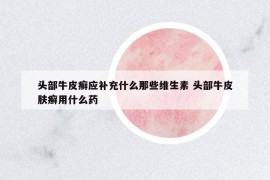 頭部牛皮癬應(yīng)補(bǔ)充什么那些維生素 頭部牛皮膚癬用什么藥