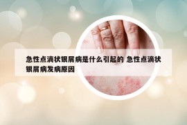 急性點(diǎn)滴狀銀屑病是什么引起的 急性點(diǎn)滴狀銀屑病發(fā)病原因