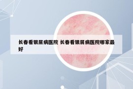 長春看銀屑病醫(yī)院 長春看銀屑病醫(yī)院哪家最好