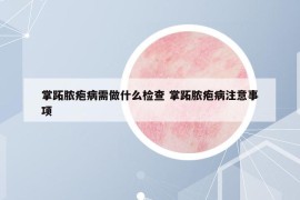 掌跖膿皰病需做什么檢查 掌跖膿皰病注意事項(xiàng)