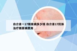 白介素一17銀屑病多少錢 白介素17抗體治療銀屑病費用