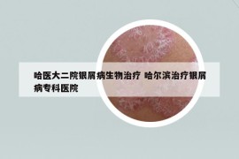 哈醫(yī)大二院銀屑病生物治療 哈爾濱治療銀屑病專科醫(yī)院