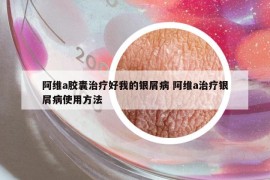 阿維a膠囊治療好我的銀屑病 阿維a治療銀屑病使用方法